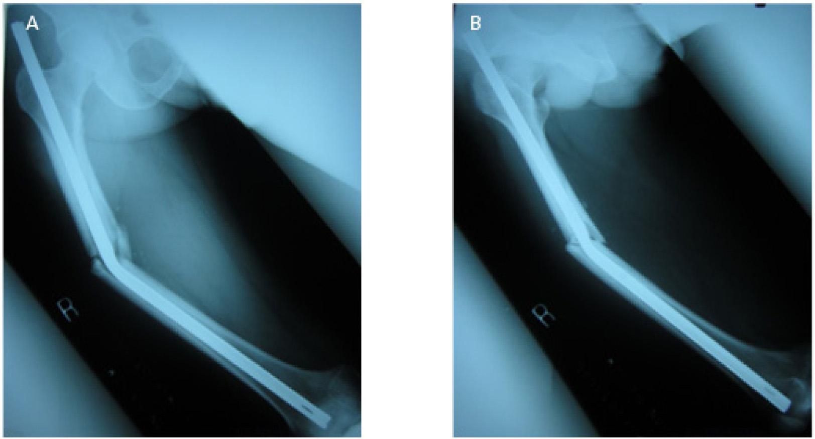 A: Lateral/oblique view of the fracture and bent intramedullary nail in right femur of a 43-year-old Cambodian man. B: Anterior–posterior view of the fracture and bent intramedullary nail in his right femur.
