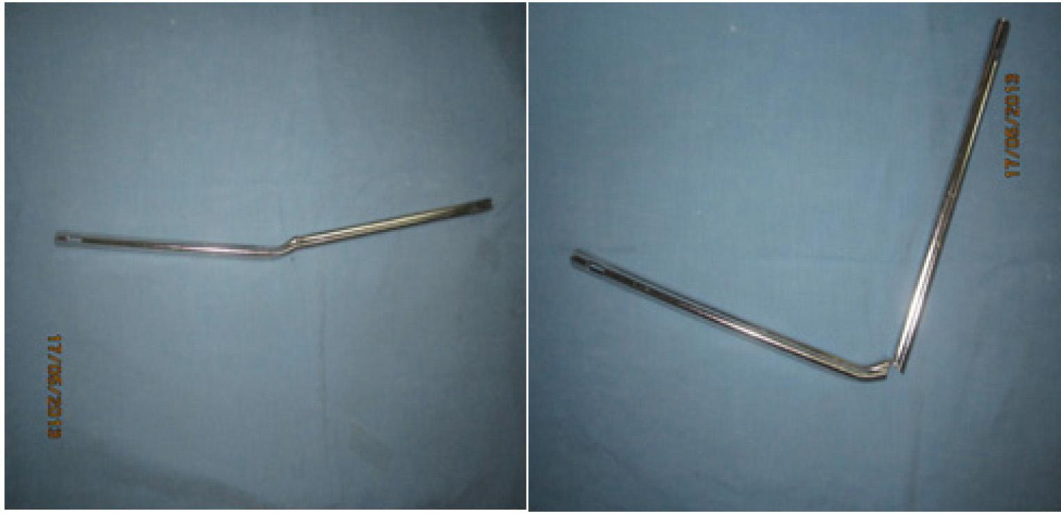 The bent intramedullary nail cut and removed intact, showing a remaining bridge of metal.