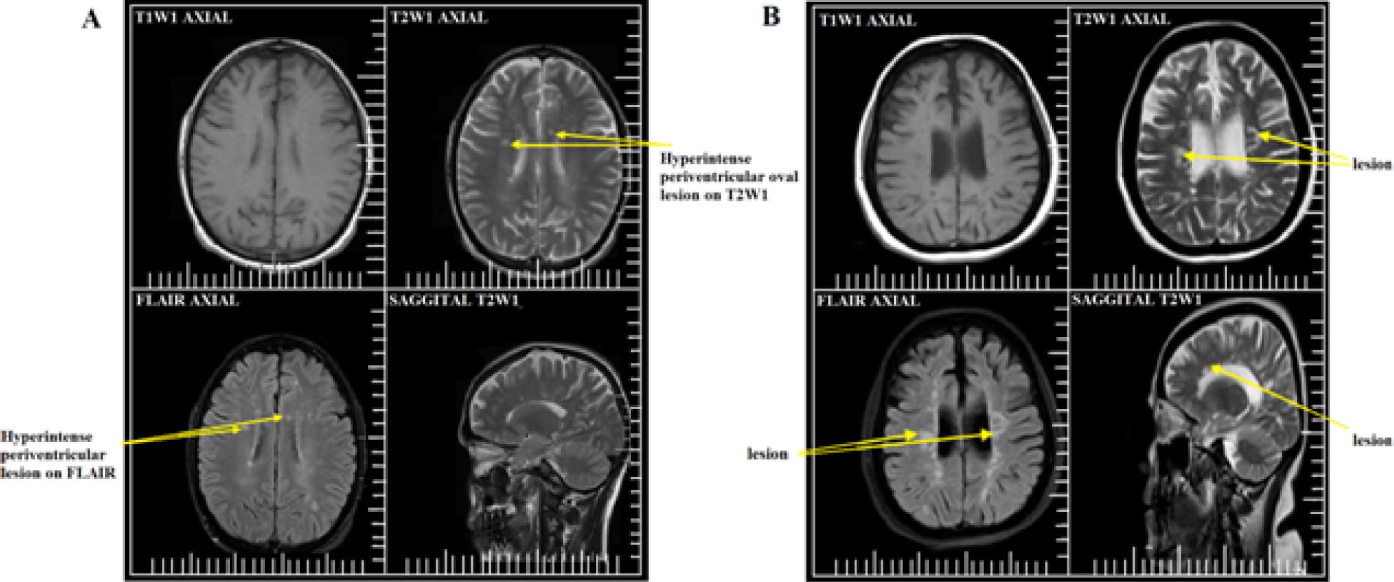 (A) A 29-year-old male patient: axial T1-weighted imaging (WI), T2WI, fluid-attenuated inversion recovery (FLAIR) imaging, and sagittal T2WI showing oval shaped white matter periventricular lesions; (B) a 38-year-old female patient: axial T1WI, T2WI, FLAIR, and sagittal T2WI showing oval shaped white matter periventricular lesions (Philips Achieva 1.5 T Nova Dual system)