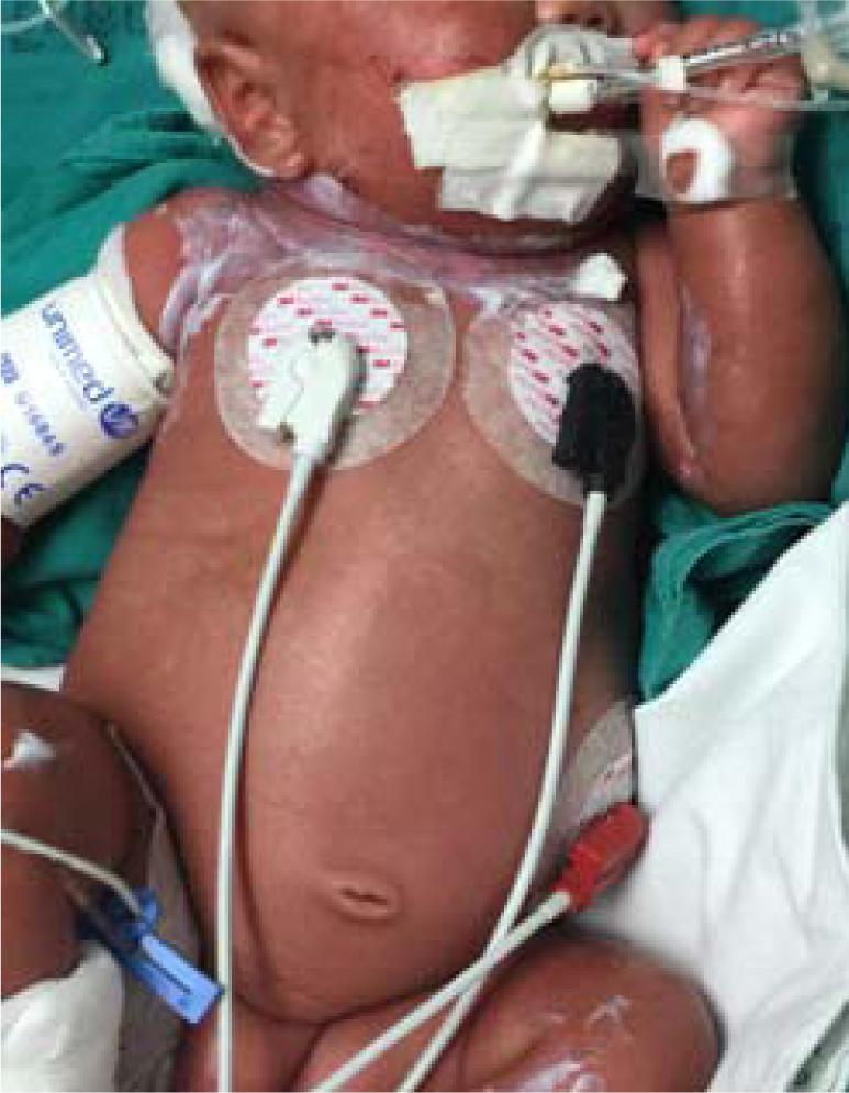 Exfoliative erythema on trunk and extremities, especially flexural areas, in a patient with methylmalonic aciduria who had excessive dietary restriction (published with written permission from the guardian).