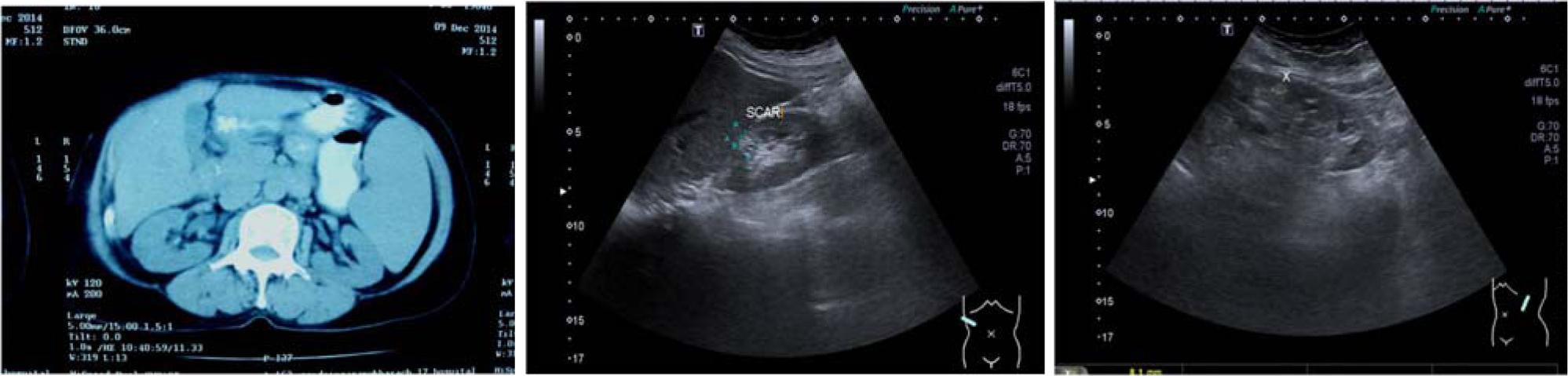 (left) CT of the abdomen of a 59-year-old Thai woman showing a huge mass anterior to her right kidney. Lymphadenopathy was not seen. The rest of the image appeared normal. (middle and right) Ultrasonography of the kidney after partial nephrectomy showed ureter and bladder, normal size kidneys, and normal cortical thickness. The size of the right kidney was 9.7 cm long with a 9 mm cortical thickness, and the left kidney was 10.1 cm long with a 10 mm cortical thickness. An echoic area suggestive of a surgical scar is noted in the right renal upper pole. The rest of the image is unremarkable with a clearly defined corticomedullary junction and smooth renal contour. There was neither definite renal stone nor hydronephrosis.