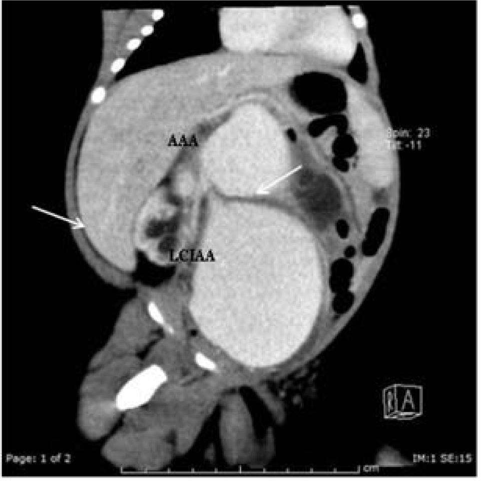 2D coronal oblique plane of the abdomen in venous phase reveals an abdominal aortic aneurysm (AAA) and left common iliac artery aneurysm (LCIAA). Bilateral hydronephroses are noted (arrows).