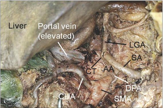 Type III celiac branching patterns. AA, abdominal aorta; CHA, common hepatic artery; CT, celiac trunk; DPA, dorsal pancreatic artery; LGA, left gastric artery; SA, splenic artery; SMA, superior mesenteric artery