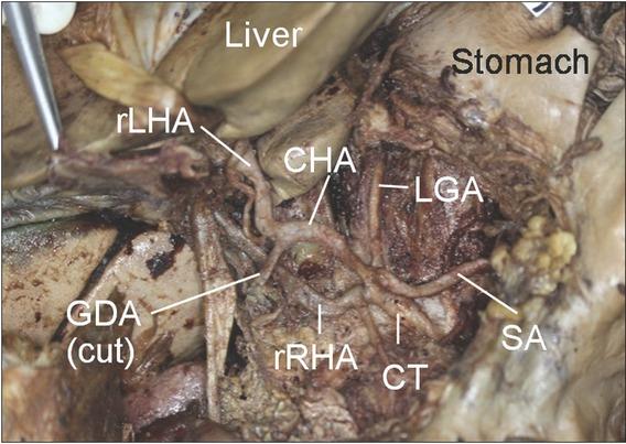 Type XIII celiac branching patterns. CHA, common hepatic artery; CT, celiac trunk; GDA, gastroduodenal artery; LGA, left gastric artery; LtIP, left inferior phrenic artery; rLHA, replaced left hepatic artery; rRHA, replaced right hepatic artery; SA, splenic artery