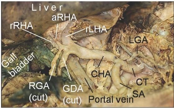 Special variation of the right hepatic artery. Both the rRHA and the aRHA arose from the CHA. aRHA, accessory right hepatic artery; CHA, common hepatic artery; CT, celiac trunk; GDA, gastroduodenal artery; LGA, left gastric artery; RGA, right gastric artery; rLHA, replaced left hepatic artery; rRHA, replaced right hepatic artery; SA, splenic artery