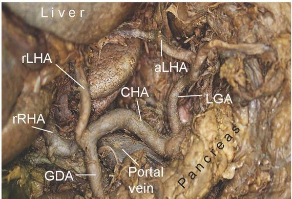 Special variation of the left hepatic artery. rLHA arose from CHA. aLHA arose from LGA. aLHA, accessory left hepatic artery; CHA, common hepatic artery; GDA, gastroduodenal artery; LGA, left gastric artery; rLHA, replaced left hepatic artery; rRHA, replaced right hepatic artery