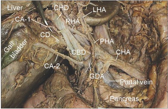 Special variation of the CA. This case had double CAs with different relations to CBD and CHD. First CA (CA-1) arose from RHA passing posterior to CBD and CHD, while another CA (CA-2) arose from GDA passing anterior to CBD and CHD. CA, cystic artery; CBD, common bile duct; CD, cystic duct; CHD, common hepatic duct; GDA, gastroduodenal artery; RHA, right hepatic artery