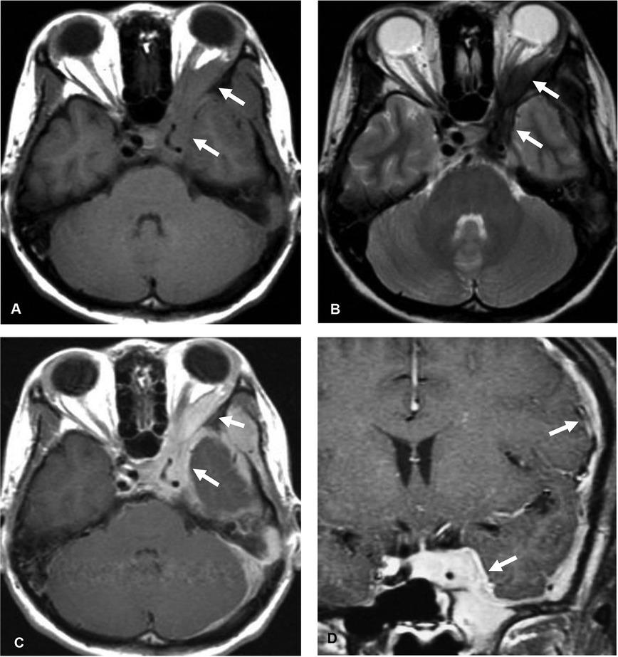 Idiopathic hypertrophic pachymeningitis (IHP). Axial T1-weighted image (A), axial T2-weighted image (B) shows an infiltrative T1 iso-intense, T2 hypointense lesion (arrow) involving left cavernous sinus with extension through left superior orbital fissure to left orbit, along left sphenoid ridge, left middle and posterior cranial fossae. Homogeneous enhancement is shown in axial (C) and coronal (D) gadolinium-enhanced T1-weighted images.