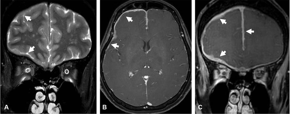 Primary dural lymphoma. Coronal T2-weighted image (A) shows hyperintense undulated thickened dura along the right cerebral convexity, anterior cranial fossa, and anterior falx cerebri (arrow). Axial (B) and coronal (C) gadolinium-enhanced T1-weighted images show homogeneously enhanced dural thickening.
