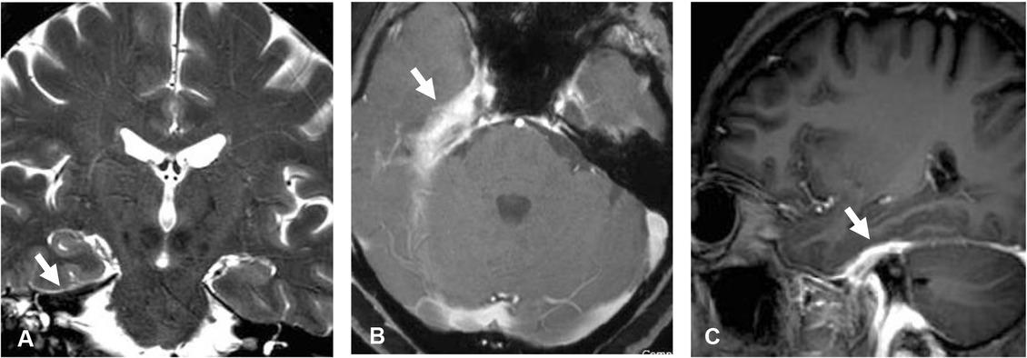IgG4-related pachymeningitis. Coronal T2-weighted image (A) shows dark intensity dural thickening involving right tentorium cerebelli (arrow). Axial (B) and sagittal (C) gadolinium-enhanced T1-weighted images demonstrate mildly heterogeneous enhancement of the thickened dura involving right medial temporal region, right Meckel’s cave, and along anterior part of right tentorium cerebelli (arrow).