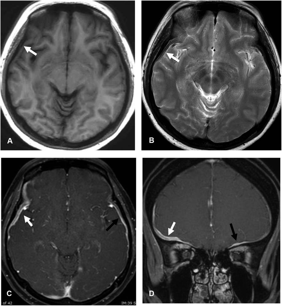 Idiopathic hypertrophic pachymeningitis (IHP) with T2-rim pattern. Axial T1-weighted image (A) and T2-weighted image (B) show T1 iso-intense and central T2 hyperintense with peripheral dark T2 intense (T2-rim pattern) of the thickened dura along right frontal and right temporal convexity (arrow). Axial (C) and coronal (D) gadolinium-enhanced T1-weighted images demonstrate rim enhancement (white arrows). Smooth and homogeneous enhanced thickened dura at left anterior cranial fossa (black arrows) is also observed.