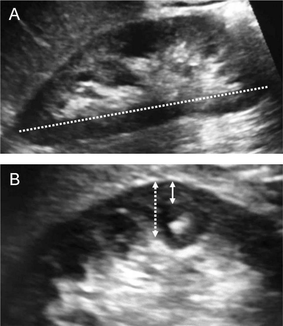 Representative ultrasound images of the kidney. A. Showing absolute renal length (RL) measurement. The white dotted line indicates the absolute RL. B. Showing cortical and parenchymal thickness measurements. The white dotted arrow indicates the renal parenchymal thickness; white solid arrow indicates renal cortical thickness.