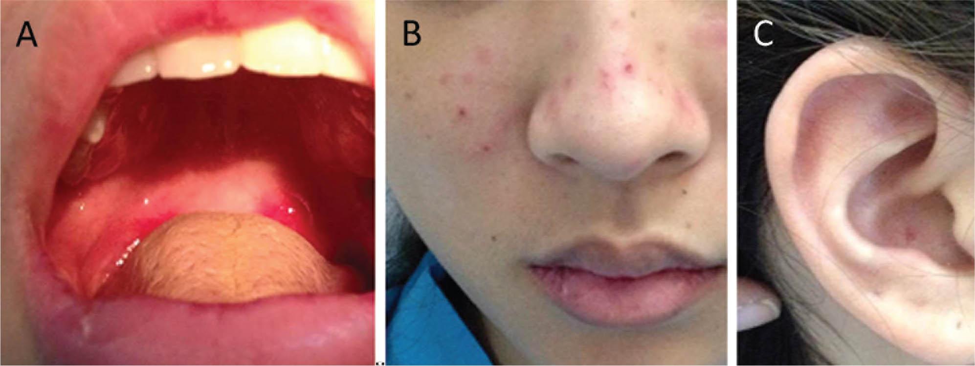Presentation of a 19-year-old acutely febrile patient from a region endemic for dengue. A. Shallow clear painless ulcer on the soft palate area. B. Erythematous macular rash on the malar area. C. Discoid rash on the ear. With consent for publication from the patient.