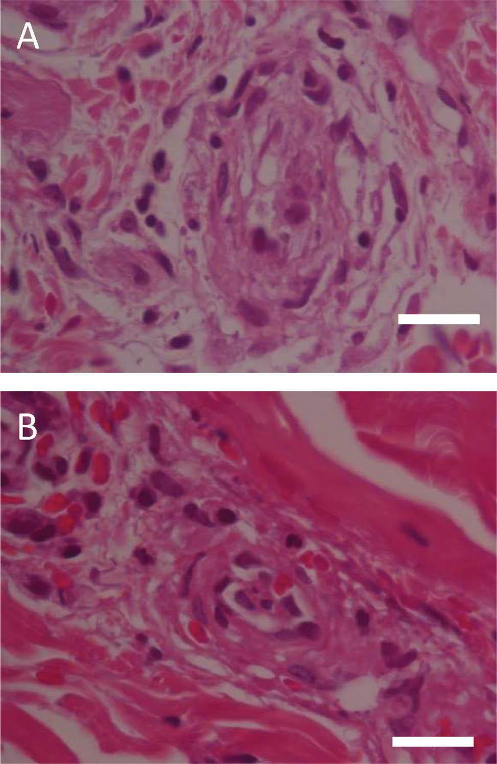 A and B. Skin biopsy from an erythematous nonblanchable patch on the abdomen of the acutely febrile patient showing a pattern of vasculitis. Dense superficial and mid-perivascular and interstitial mixed inflammatory cell infiltrate composed of lymphohistiocytes, neutrophils, a few nuclear remnants, and extravasated red blood cells (hematoxylin and eosin staining; original magnification ×100; scale bars indicate 10 μm).