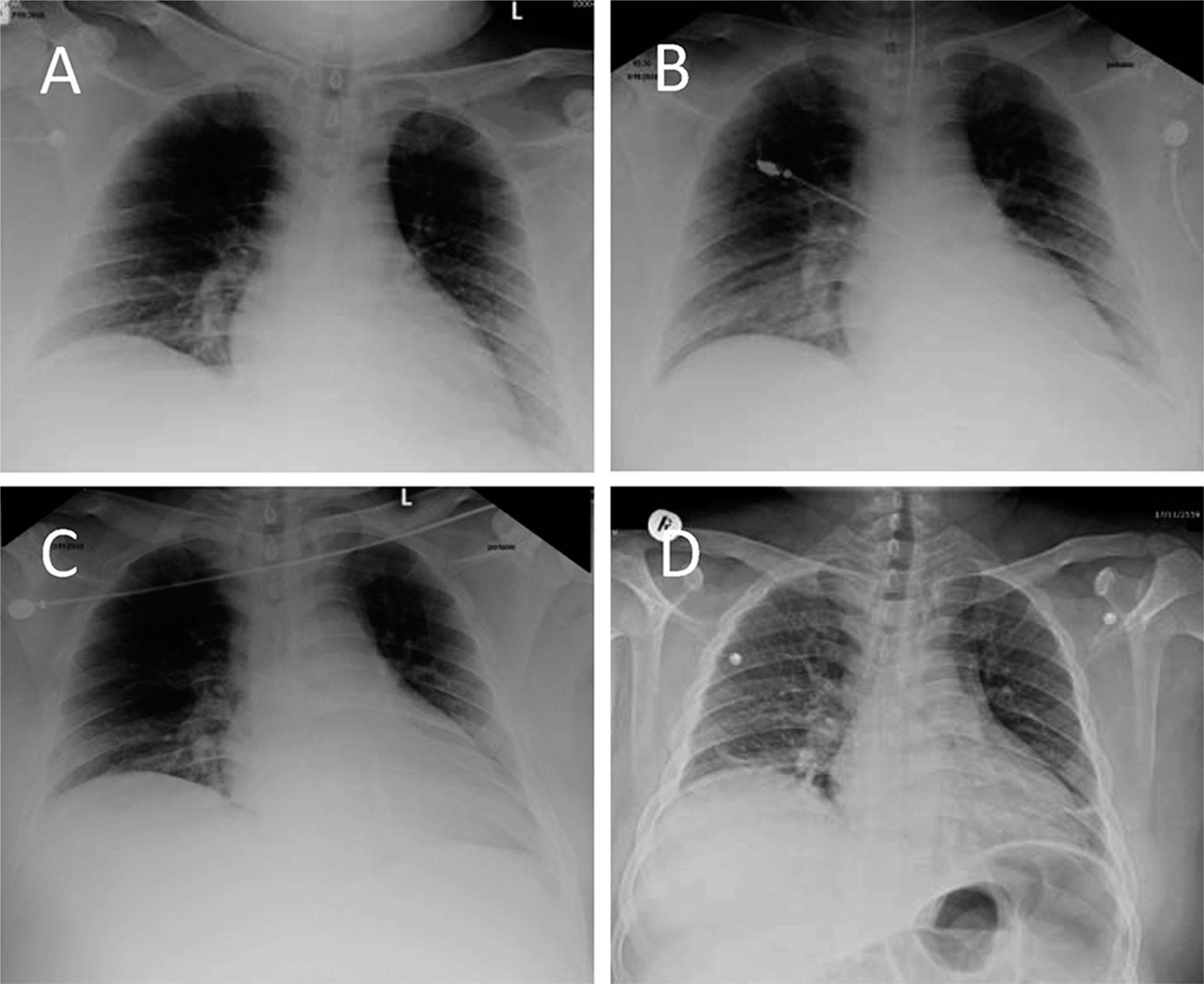 A. Posterior–anterior chest X-ray image demonstrating a slight radiographic sign that suggests interstitial pulmonary edema. B. Supine radiogram demonstrating redistribution of lung circulation from base to middle, suggestive of pulmonary congestion. C. Endotracheal tube inserted after persistent pulmonary congestion. D. Posterior–anterior chest X-ray image showing with normal lung marking and heart size.