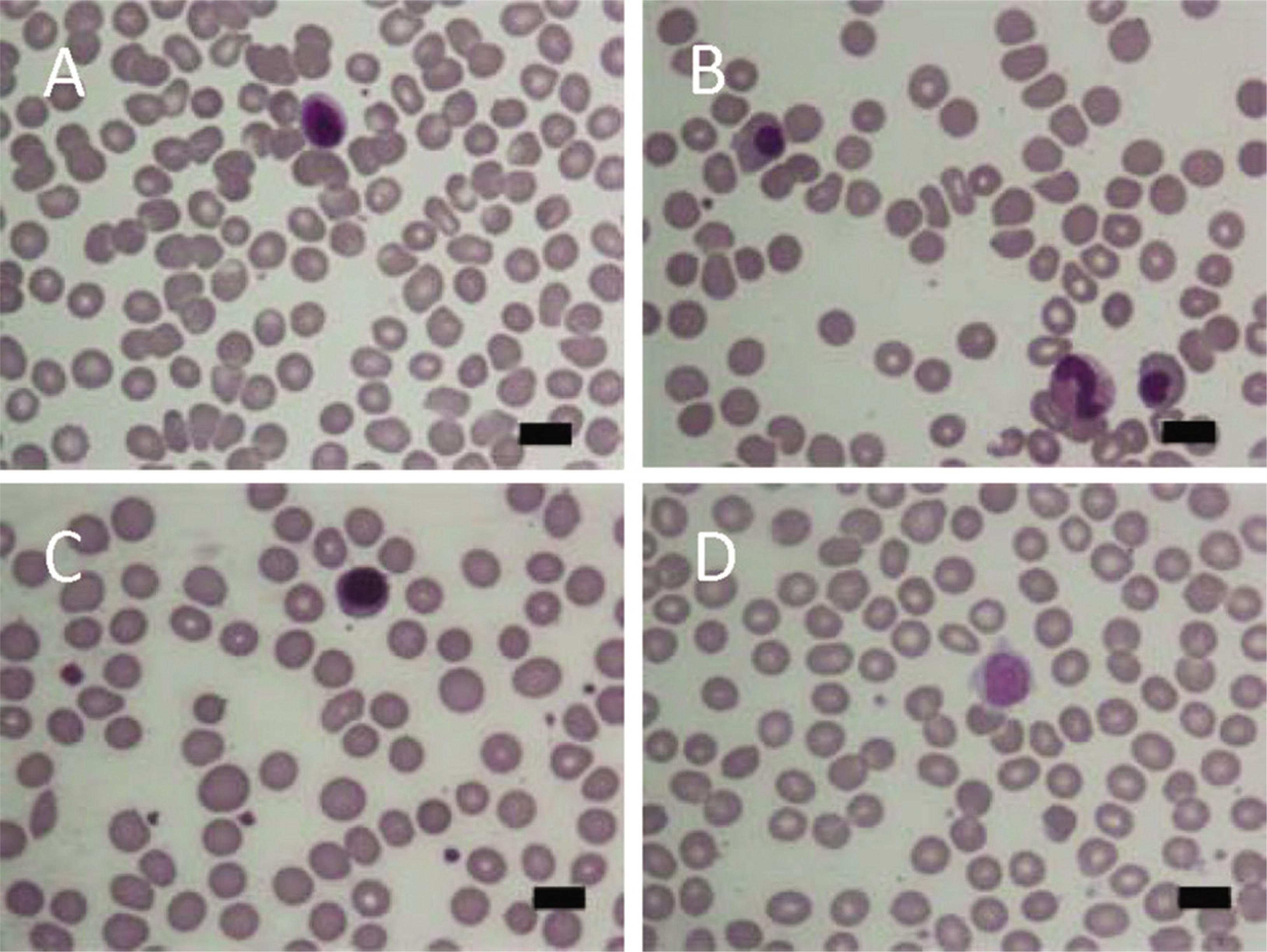 A. Peripheral blood smear during febrile phase showing normochromic and normocytic red blood cells, white blood cells with predominating lymphocytes and atypical lymphocytes, with slight thrombocytopenia. B. Peripheral blood smear (during shock stage with intractable bleeding on the first week of hospitalization) showing a decreased number of red blood cells with nucleated red blood cells, and a scanty number of platelets. C. Peripheral blood smear on the second week of hospitalization, showing microspherocytes, polychromasia of red blood cells with predominating polychromatosis, white blood cells, and platelets within normal reference ranges. D. Peripheral blood smear during recovery phase showing red blood cells, white blood cells, and platelets within normal reference ranges. All micrographs are shown with Wright–Giemsa staining (original magnification×1000). Scale bars indicate 10 μm.