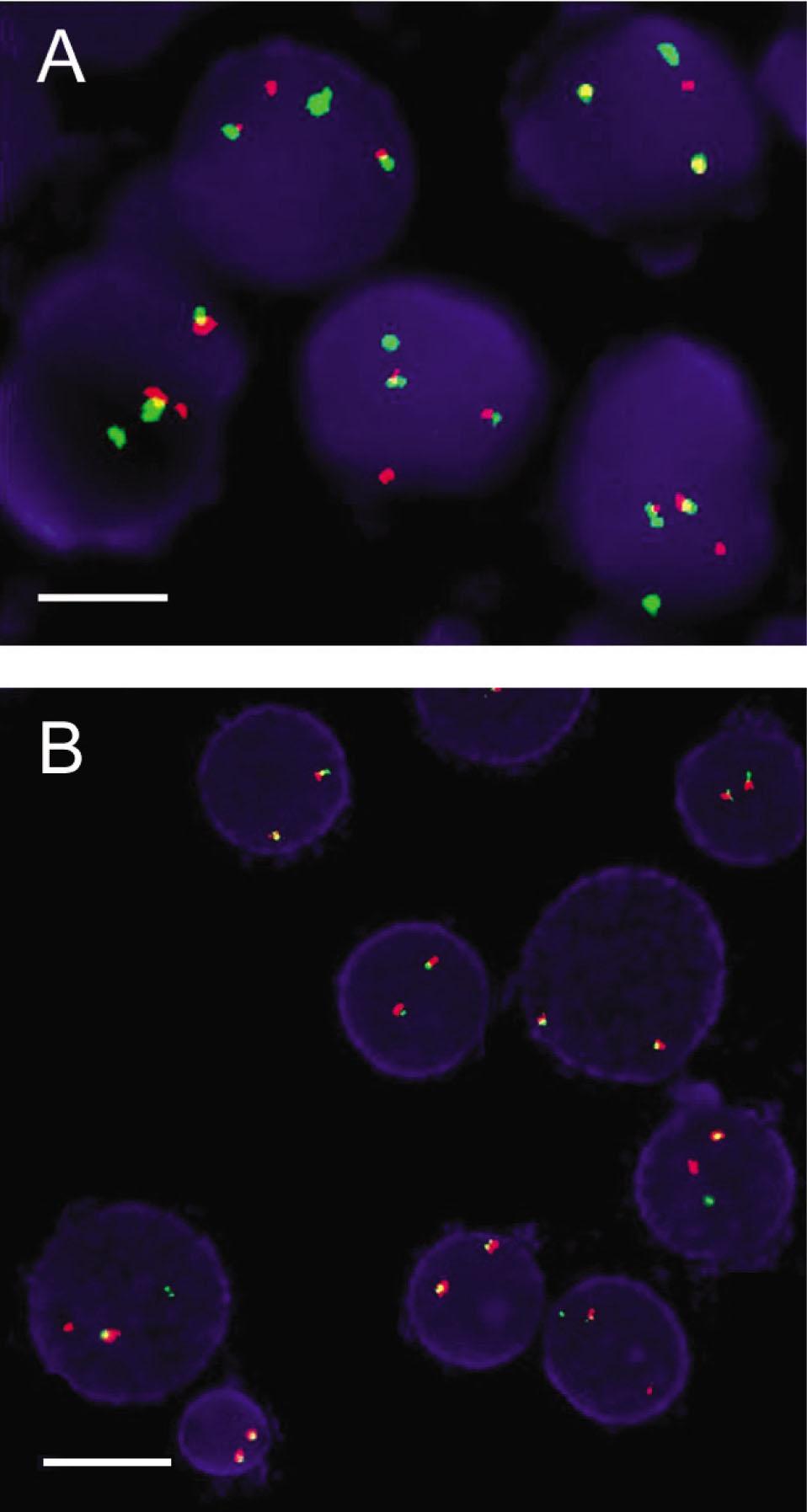 FISH results. A. RUNX1-RUNX1T1 fusion, 2Y1R1G, ×1000, B. MLL breakage, 1Y1R1G, ×1000. When gene fusion occurred, two yellow fusion signals are produced by the proximity or superposition of green and red chromosomes, one red and one green (2Y1R1G) signal are presented. If not, two red and two green signals were presented (2R2G). When gene breakage occurred, one yellow chromosome breaks apart as one red and one green (1R1G) signal, and one yellow signal is presented (1Y1R1G). If not, two yellow signals are presented (2Y). Scale bars indicate 10 μm. FISH, fluorescence in situ hybridization.