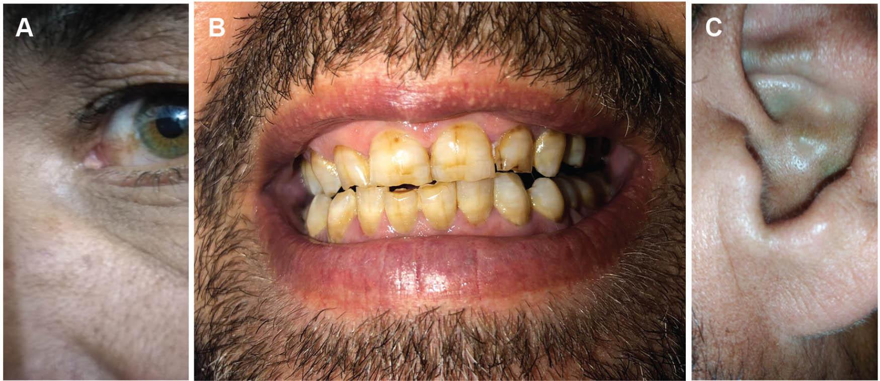 Clinical manifestations of alkaptonuria presented in the reported case. (A) Brownish discoloration of the eye sclera, (B) discoloration of the teeth, (C) bluish discoloration of the ear pinna. With documented consent for publication from the patient.