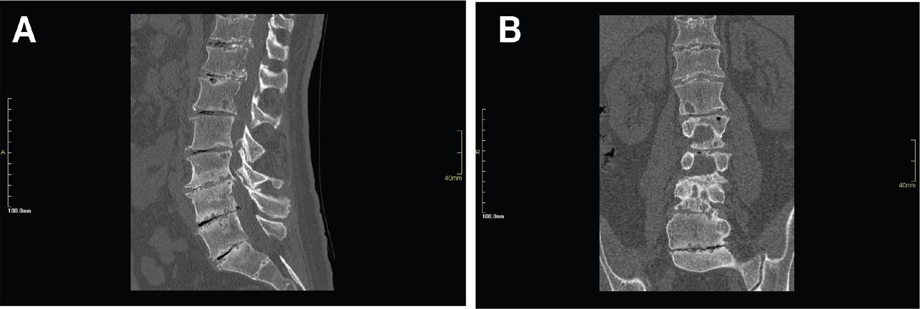 Computed tomographic sagittal (A) and coronal (B) reconstruction of the lumbosacral spine showing diffuse degenerative changes represented by disk space narrowing, subchondral cystic changes and erosions, multilevel endplate sclerosis, marginal sydesmophytosis, and the presence of gas in the degenerated disk spaces (vacuum phenomenon). In addition, evidence of disk calcification is noted in the upper disk space level.