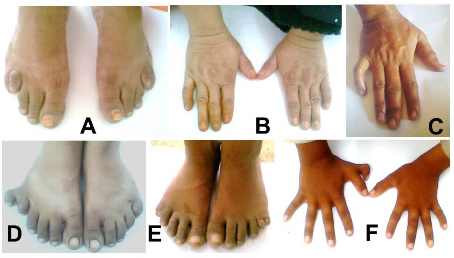 Phenotypic presentation of hereditary limb anomalies among the participants. (A) Bilateral brachymetatarsia of 4th toes. (B) Brachydactyly type A4 depicting bilaterally small 2nd and 5th fingers. (C) Camptodactyly of right 5th finger. (D) Postaxial polydactyly type A of right foot. (E) Bilateral postaxial polydactyly of 5th toes (polysyndactyly of 5th to 6th toes). (F) Preaxial polydactyly (hyperdactyly) of right hand marked by the presence of a supernumerary digit. With documented informed consent for publication from each participant or with their assent and consent from their husband or husband's first degree relative.