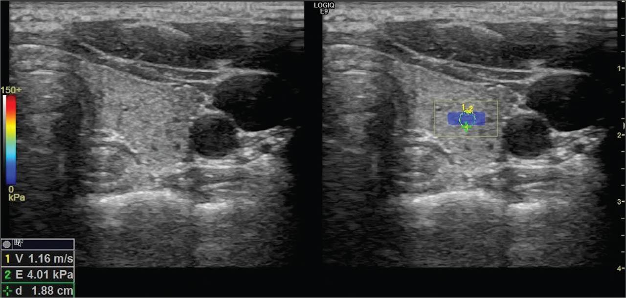 SWV measurement in a healthy patient in the control group generated by the acoustic radiation force impulse. SWV (1.16 m/s) reflects tissue elasticity, which can be calculated using Young's modulus. Thus, shear wave elasticity can be used to evaluate tissue stiffness, both quantitatively and objectively. Parenchymal stiffness measured in the ROI on the left lobe was 4.01 kPa. ROI, region of interest; SWV, shear wave velocity.