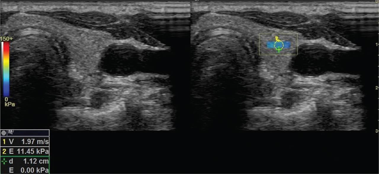 Shear wave velocity measurement in a patient with SCA. Parenchymal stiffness measured in the ROI on the left lobe was 11.45 kPa. ROI, region of interest; SCA, sickle cell anemia.