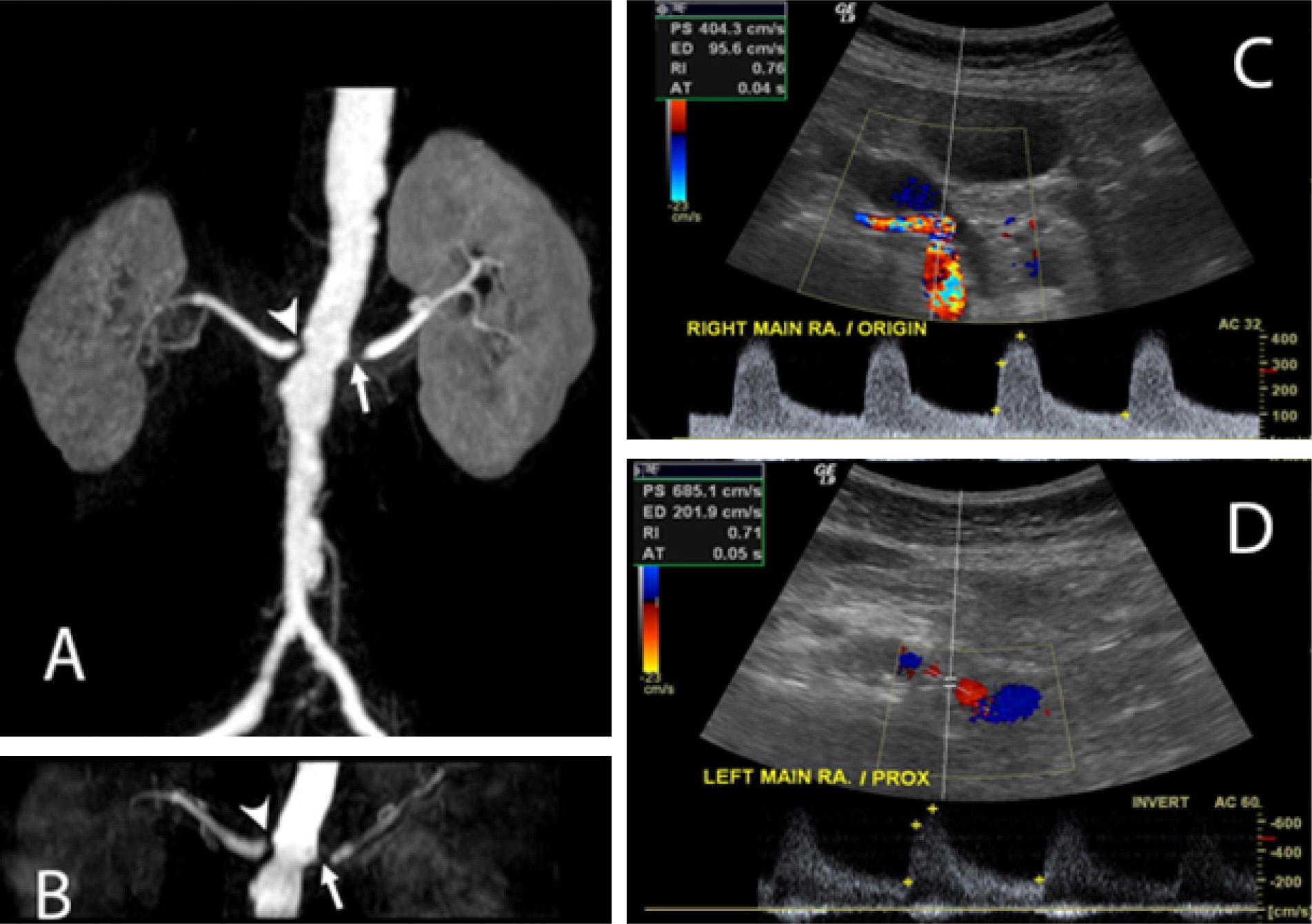 Severe bilateral renal artery stenosis was diagnosed in an 80-year-old patient. Arrow heads and arrows show severe renal artery stenosis at the proximal right and left main renal arteries in both contrast-enhanced magnetic resonance angiography (MRA) (A) and noncontrast enhanced MRA (B). Color Doppler ultrasound of right and left main renal arteries (C and D) showed aliasing color and high peak systolic velocities, indicating severe renal artery stenosis.