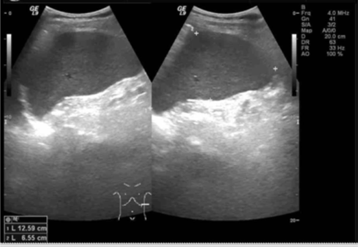 Ultrasound images show splenomegaly (size 6.6 cm × 12.6 cm) without a focal mass. No ascites or lymphadenopathies were noted.