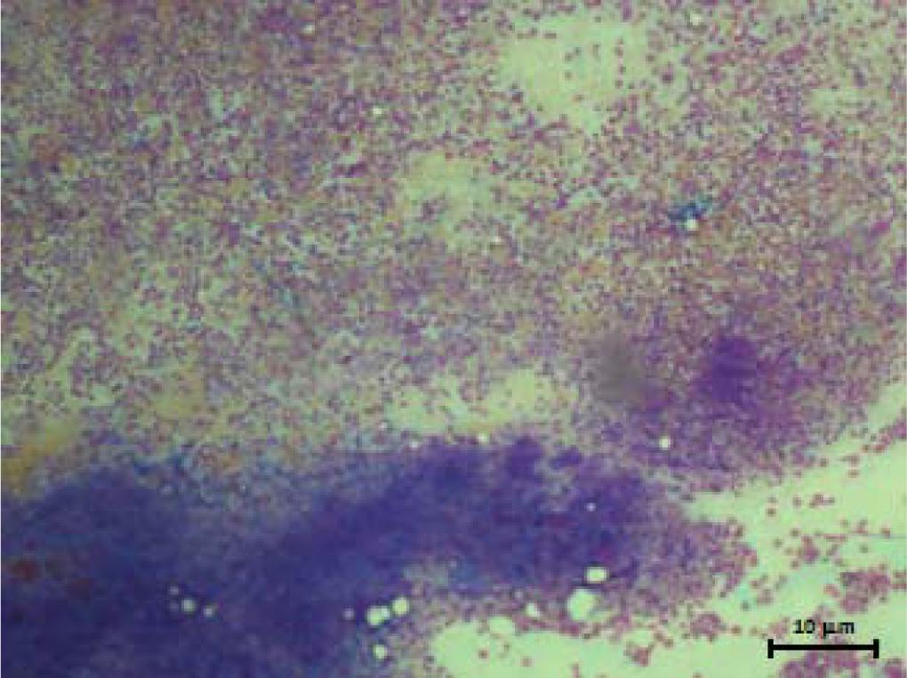 Micrograph showing hypercellularity with prominent proliferation of erythroid cells, increased megakaryocytes of varying in shapes and sizes (Wright–Giemsa stain, ×400; bar 60 μm)
