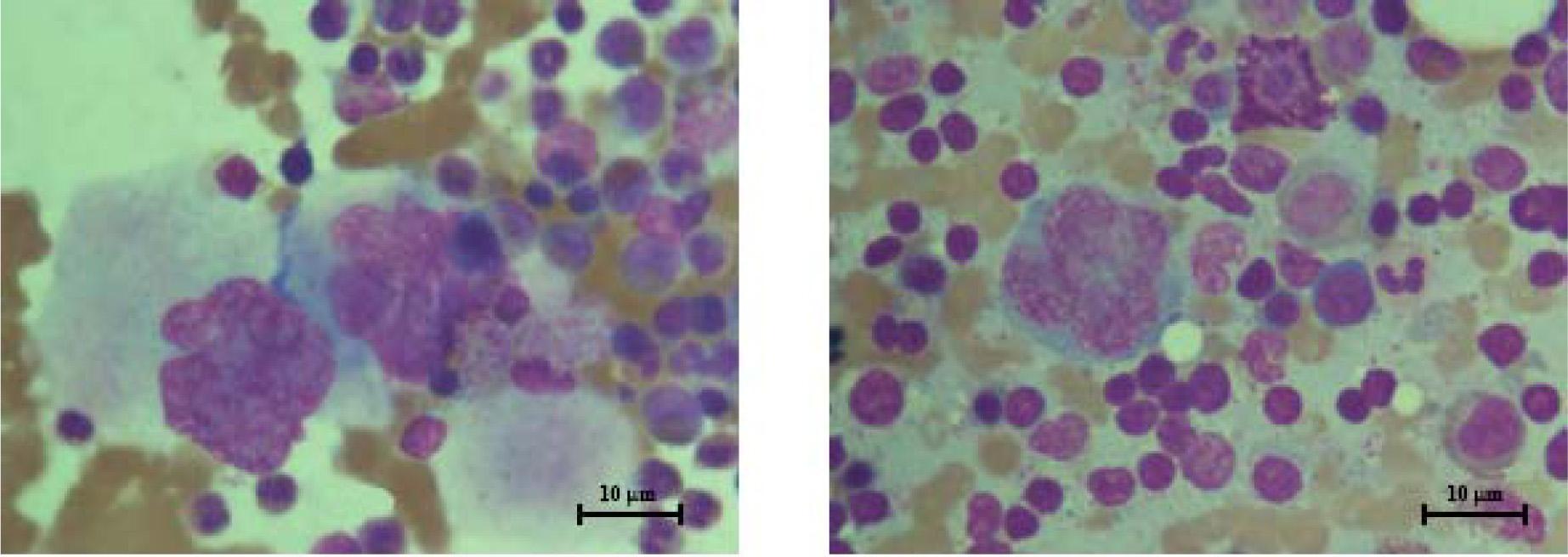 left and right: Megakaryocytes from bone marrow aspirates showing megakaryocytes with a nuclear chromatin pattern varying from dispersed, no megakaryocytic clusters were seen, no dysplastic changes and no increase in blasts were noted (Wright–Giemsa stain, ×1,000; bars 10 μm).