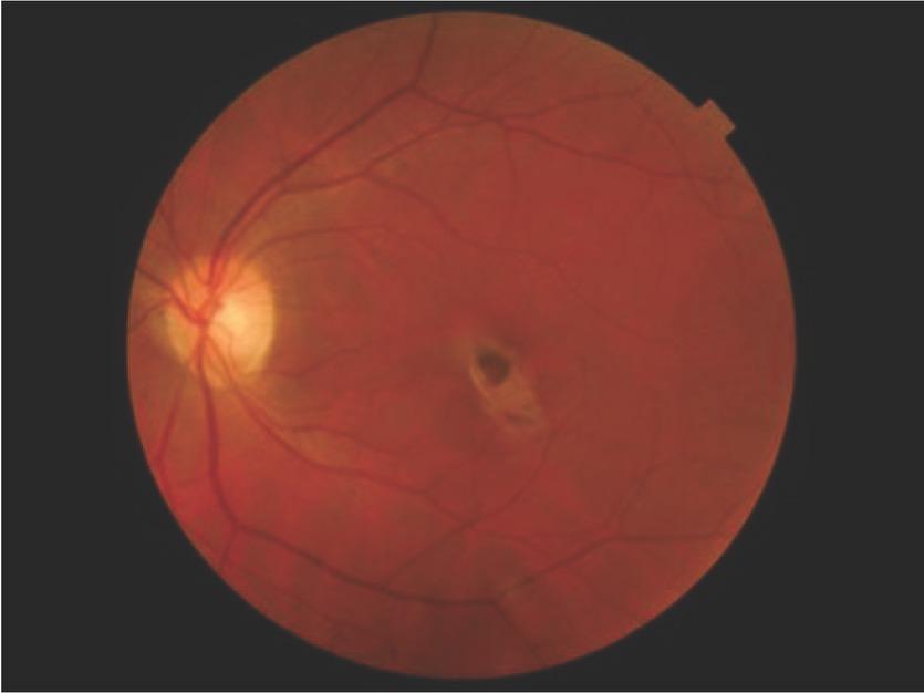 On admission, color fundus photograph of the left eye showing an inactive retinochoroidal scar