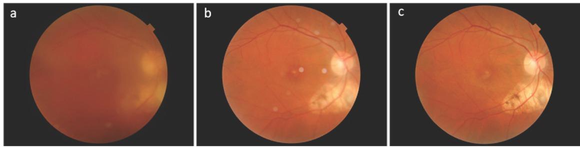 a - Blurred color fundus photograph of the right eye due to severe vitritisb,c - Follow up, color fundus photograph of the right eye showing resolution of the lesions