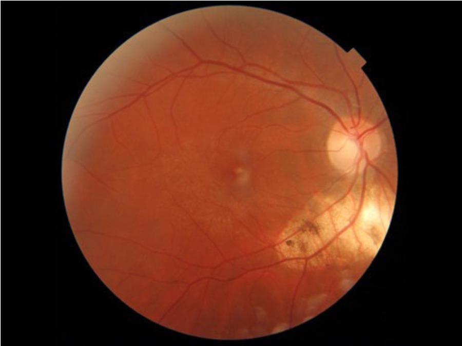 Photograph of the fundus of the right eye presenting resolution of ocular toxoplasmosis following the treatment