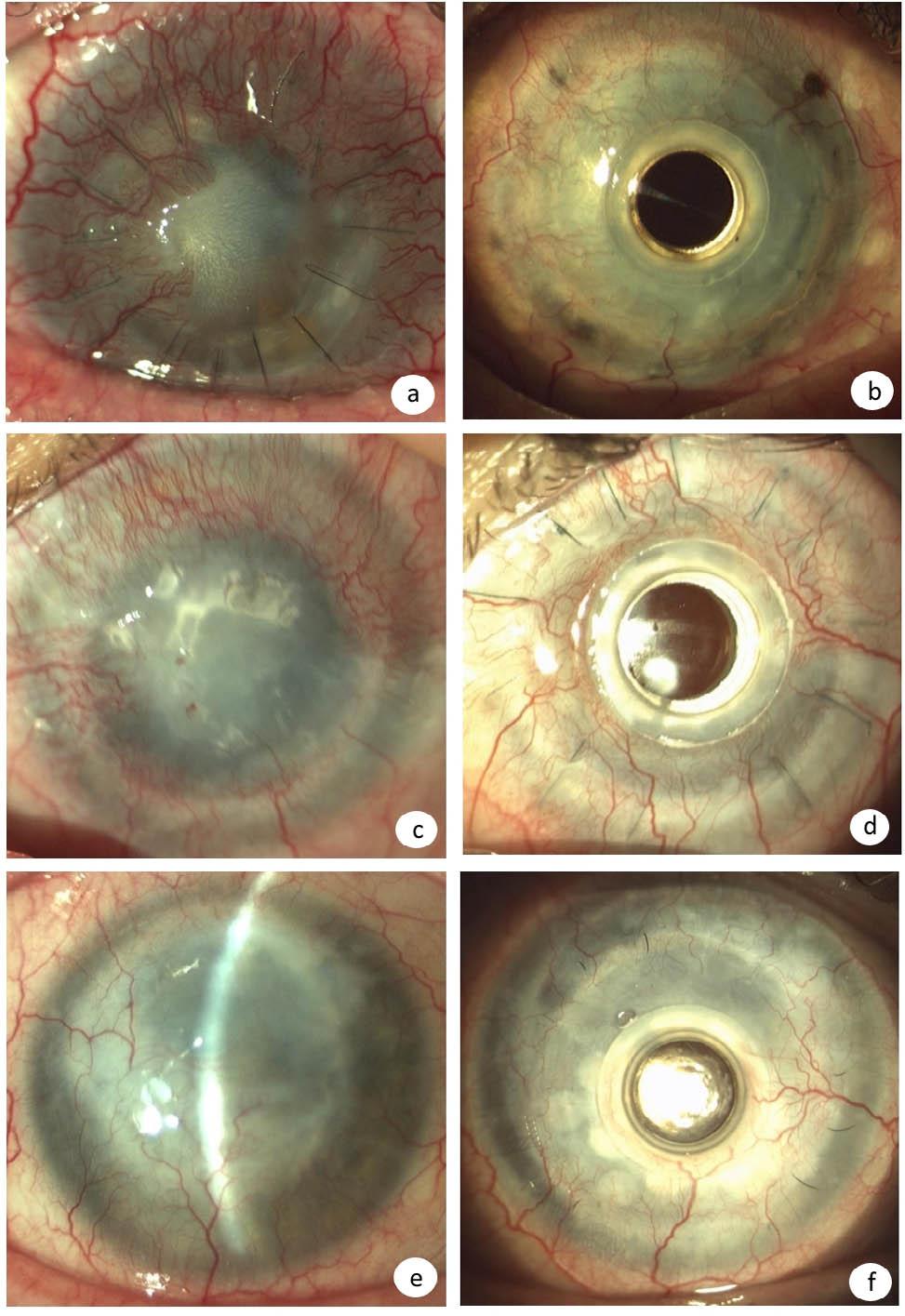 Representative images of patient's eyes preoperatively and at the last recorded visit; 1a, b. Patient PV.a. Preoperatively. Failed graft with interrupted sutures. Limbal stem cells deficiency after thermal corneal burn.b. Postoperatively. Proper BKPro retention. Soft contact lens on ocular surface. Multiple peripheral invasion of blood vessels over the cornea due to limbal stem cell deficiency.1 c, d. Patient PIII.c. Preoperatively. Failed graft. Corneal leucoma with calcification and vascularization. Axenfeld-Rieger syndrome.d. Postoperatively. Proper BKPro retention. No contact lens on ocular surface. Multiple invasion of blood vessels over the cornea exceeding to the device border.1 e, f. Patient PI.e. Preoperatively. Post-herpetic keratitis, vascularized leucoma.f. Postoperatively. Proper BKPro retention. Soft contact lens on ocular surface.