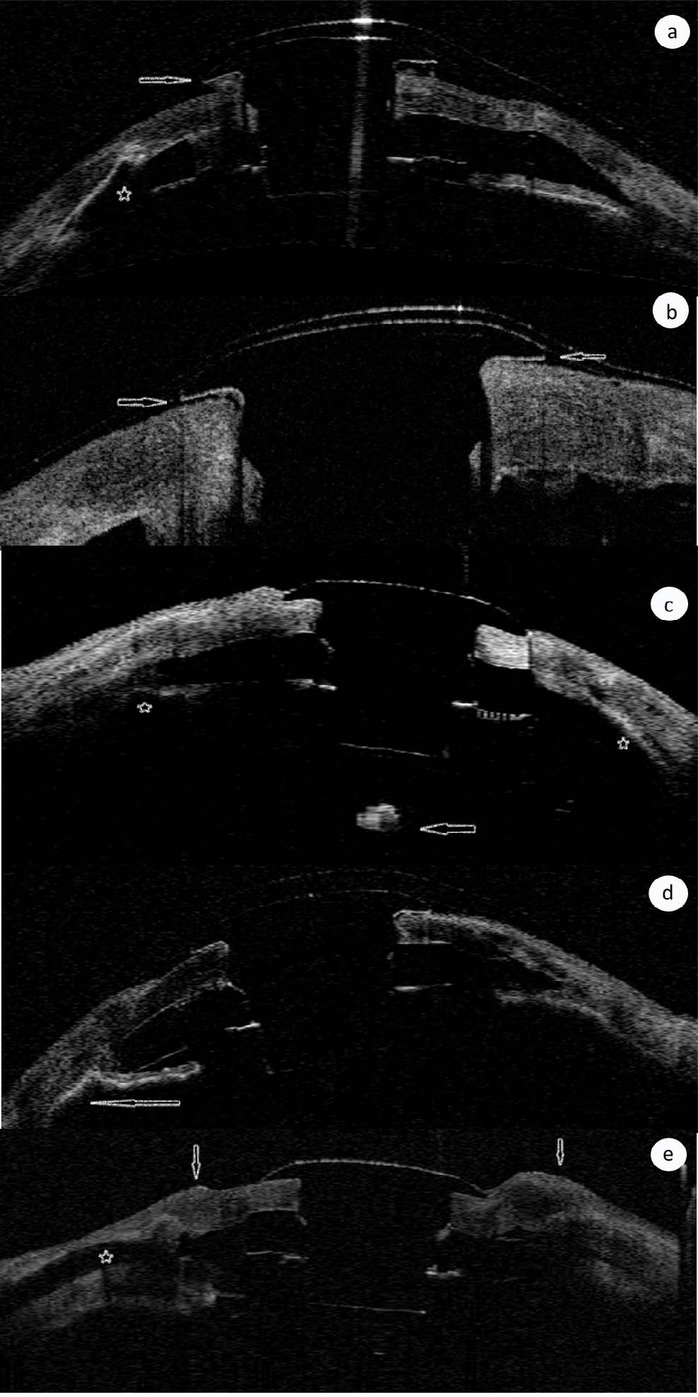 TD OCT representative scans showing complications which occurred in the presented case series.2 a, b. Patient PII.a. AS OCT scan 4 weeks postoperatively. Protrusion of the front plate elevated over the ocular surface (arrow). Soft contact lens on the ocular surface. Iris anterior synechiae at 180o with ACA closure (*). ACA open at 0o.b. HR OCT scan 12 months postoperatively. The protrusion is resolved (arrow). Proper BKPro retention. Soft contact lens on the ocular surface.c. Patient PIII. AS OCT scan 12 months postoperatively. No contact lens on the ocular surface. Iris atrophy with anterior synechiae (*). Retroprosthetic highly reflective tissue visible behind the optic BKPro part (Retroprosthetic membrane formation) (arrow).d. Patient PV. AS OCT scan 24 months postoperatively. Anterior iris synechiae with complete ACA closure at 180o (arrow). Soft contact lens on the ocular surface.e. Patient PIV. AS OCT scan 10 years postoperatively. AGV tube visible at the 180o (*). Note the irregularity of the anterior ocular surface due to severe chemical ocular burn with the pannus formation (arrows). No soft contact lens on the ocular surface.