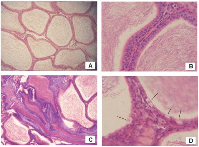 Photomicrographs of rats epididymis stained with haematoxylin and eosin; (A and B) normal epididymis tubule structure in control rats (100x and 400x magnification, respectively); (C) focal luminal sperm stasis in HF rats (100x magnification); (D) epithelial clear cell hyperplasia in HF rats (400x magnification)