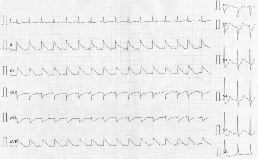 Electrocardiogram monitoring showing acute STEMI in inferior territory. ECG at the Cardiology Department revealed acute ST-elevation in inferior territory and sinus tachycardia