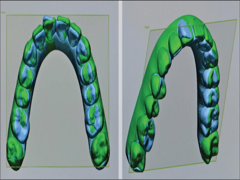 The best fit superimposition with a common transverse reference plane for both pretreatment and predicted post-treatment STL files.