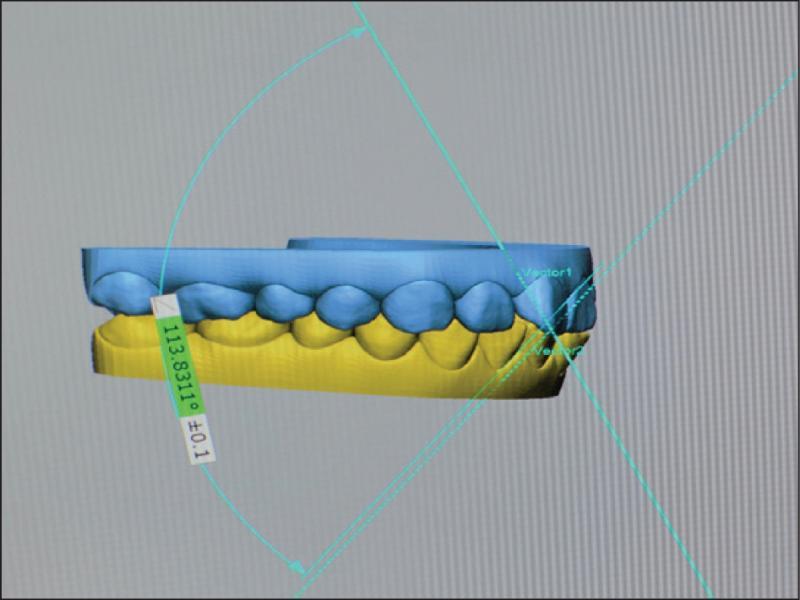 Measurement of interincisal angle.