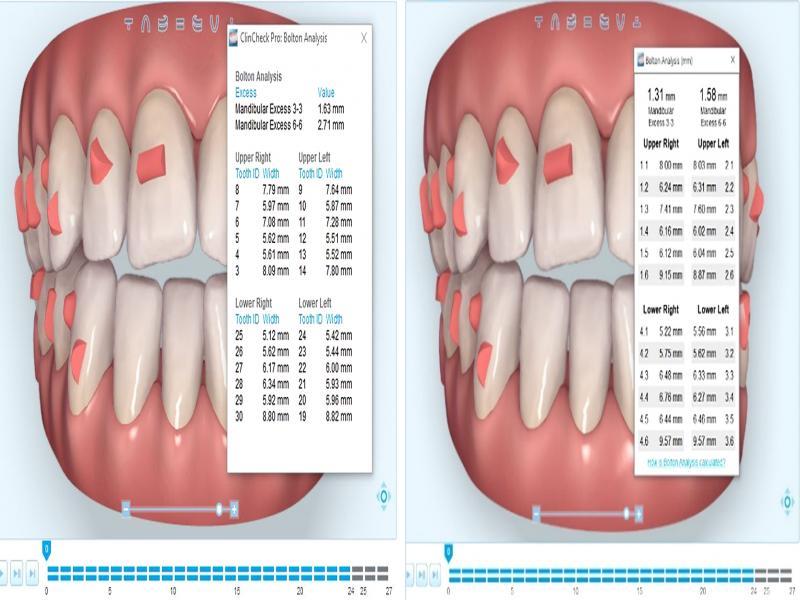 Tooth measurements supplied for the same case showing variations between different versions of ClinCheck. Left is using Old CC Pro, right is New CC Pro.
