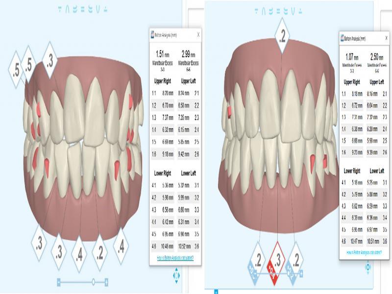 Showing pre- and post-IPR measurements from ClinCheck.