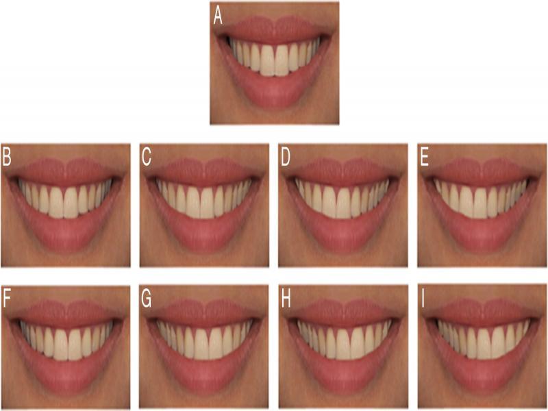 The study photograph and eight modified smile photographs. The dental midline was shifted to the left and right segments gradually. A. Dental Midline In Place (DML0). B. Shifted Dental Midline 1 mm Right (DML1R). C. Shifted Dental Midline 2 mm Right (DML2R). D. Shifted Dental Midline 3 mm Right (DML3R). E. Shifted Dental Midline 4 mm Right (DML4R). F. Shifted Dental Midline 1 mm Left (DML1L). G. Shifted Dental Midline 2 mm Left (DML2L). H. Shifted Dental Midline 3 mm Left (DML3L). I. Shifted Dental Midline 4 mm Left (DML4L).