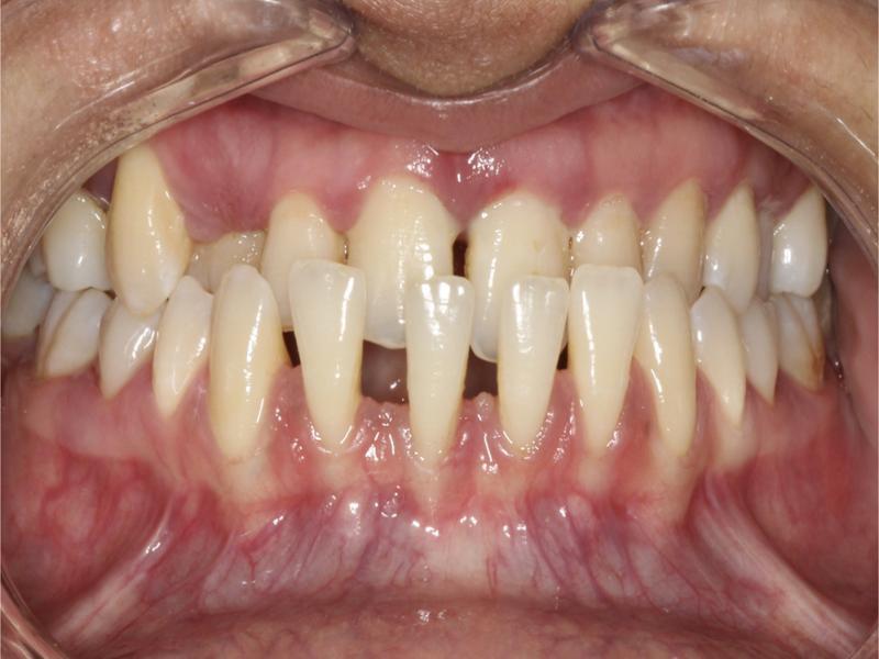Intraoral photograph taken during the periodontal examination.