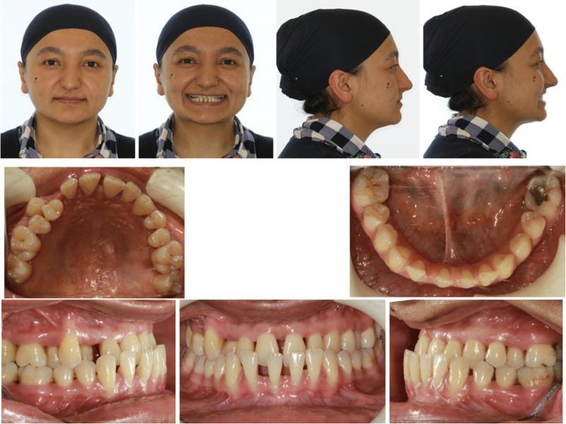 Pretreatment extraoral and intraoral photographs.