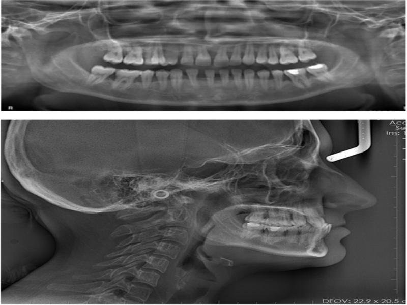 Pretreatment panoramic X-ray and lateral cephalogram.