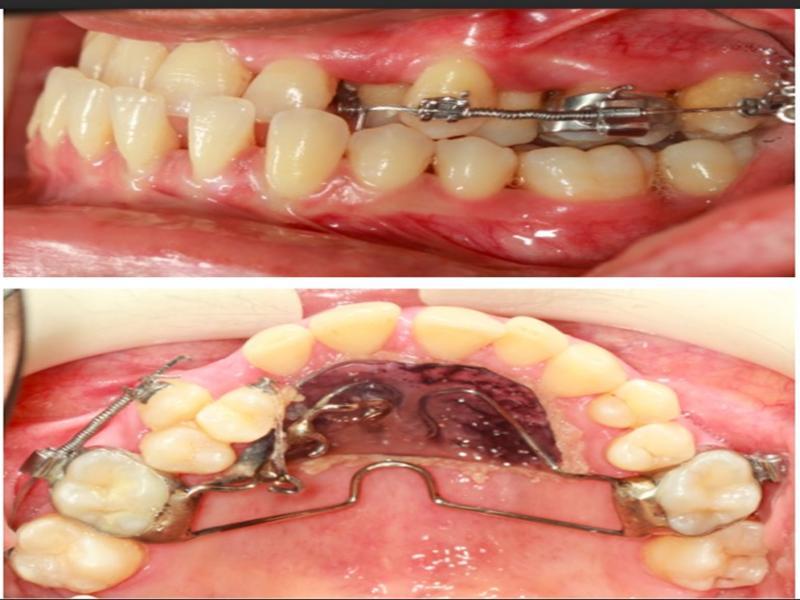 Correction of the transposition using a modified Nance-TPA appliance and sectional arch mechanics.