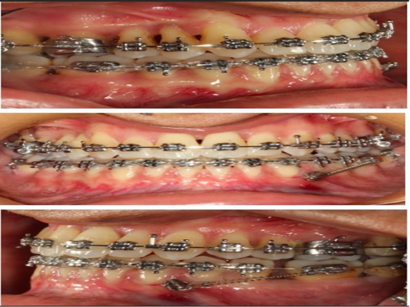Correction of the midline deviation by mesializing the left posterior teeth using mini-screw anchorage.