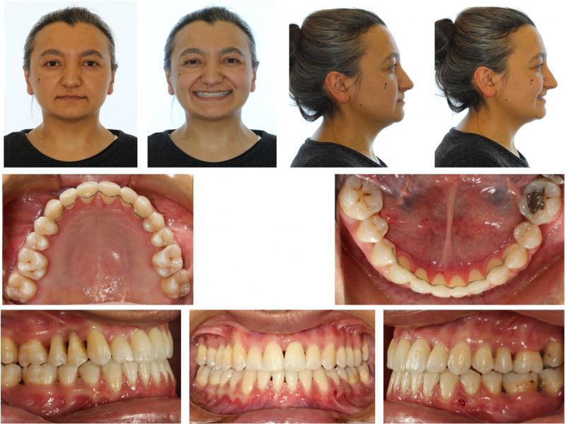 Posttreatment extraoral and intraoral photographs.