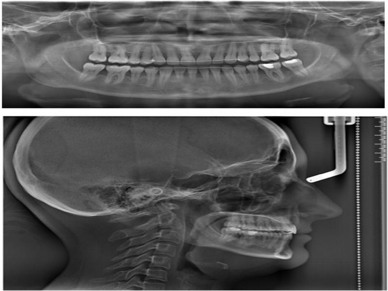 Posttreatment panoramic X-ray and lateral cephalogram.