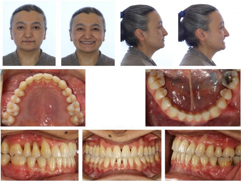 Extraoral and intraoral photographs at 2-year follow-up.